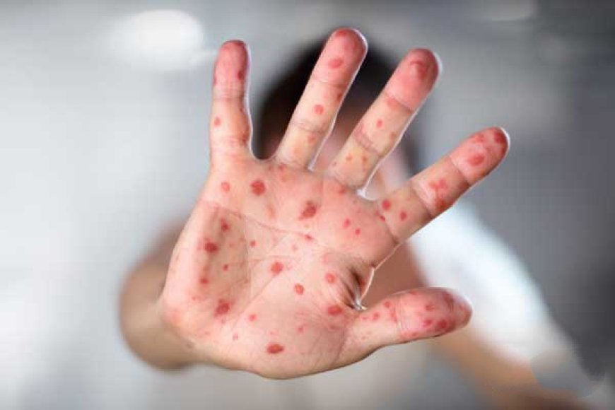 همه‌چیز در مورد یک ویروس بهاری؛ بیشتر مراقب کودکان خود باشید