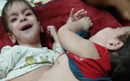 جداسازی موفقیت آمیز دوقلوهای به هم چسبیده اهوازی در بیمارستان نمازی شیراز