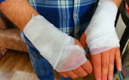 سالانه ۳ هزار ایرانی بر اثر سوختگی می‌میرند