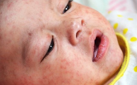 زنگ خطر شیوع سرخک در دزفول به صدا در آمد