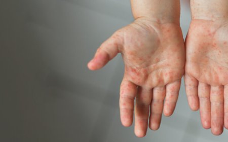 تب سرخک در فارس؛ آیا واکسن می‌تواند آتش بیماری را خاموش کند؟
