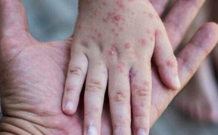 هشدار سرخک در فارس؛ شناسایی ۲۰ بیمار قطعی در میانه موج کنترل شده