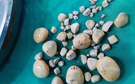 ۶۷ سنگ با ابعاد مختلف از مثانه بیمار در بیمارستان گناوه خارج شد