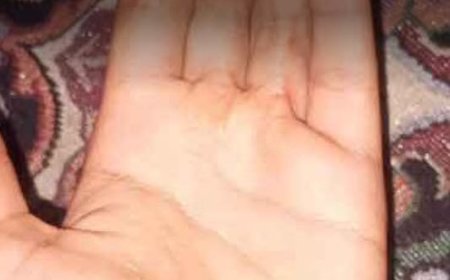 دست سوخته دخترروستایی؛ وقتی پول نیست، درمان هم نیست